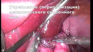 Мини   гастрошунтирование Астана Казахстан Бариатрия Снижение веса при ожирении