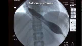 Akalazya tedavisinde balonla genişletme ve hemen sonrasında hastamız
