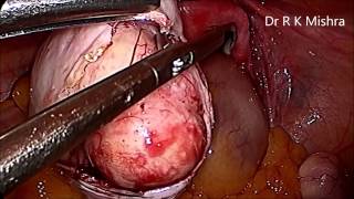 Myomectomy and Dermoid Ovarian Cystectomy