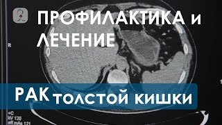Рак толстой кишки. Перспективы лечения рака толстой кишки. Клиника колопроктологии.