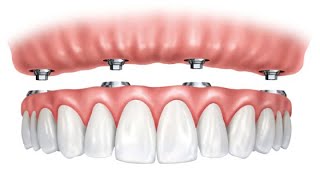 Trồng răng toàn hàm bằng công nghệ Cấy ghép Implant All-ON-4