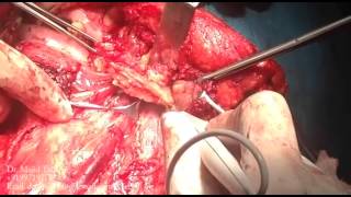 commando surgery (hemi mandibulectomy + neck dissection+pectoral major flap)