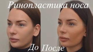 Ринопластика До и После - Пластика Носа