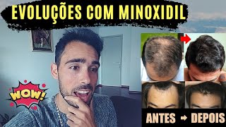 Evoluções com Minoxidil - Resultados Impressionantes!