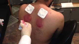 Cupping Lesson 7 الحجامه: Cupping The Back