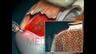 3D Medical Animation |  Arthroscopic repair with anchors and sutures of rotator cuff tear