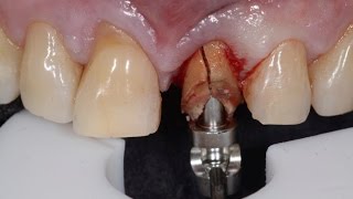 (18+) Atraumatic Tooth Extraction (ถอนฟันแบบไม่บาดเจ็บ)