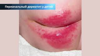 Перианальный дерматит у детей и взрослых: лечение, причины, симптомы, фото