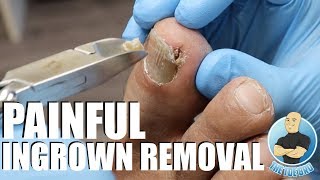 TREATING AN EXTREMELY PAINFUL INGROWN TOENAIL WITH 'HOW TO' ADVICE