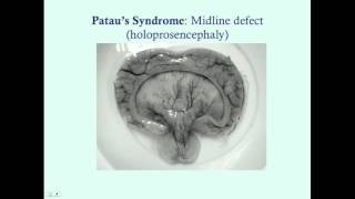 Patau's and Edward's Syndrome - CRASH! Medical Review Series