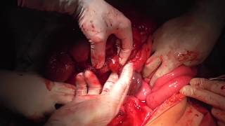 ectopic spleen, 17.5.2019