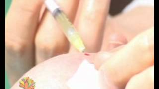 Cấy ghép tế bào gốc - Vui Sống Mỗi Ngày [VTV3 - 12.06.2012]