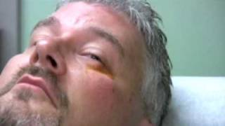 Chalazion Injection Demonstration