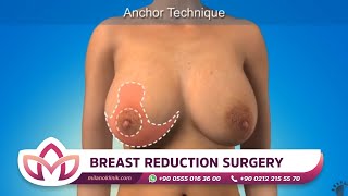 What is BREAST REDUCTION SURGERY? | Milano Clinic TURKEY