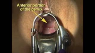 Technique of Pelvic Examination