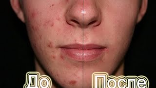 PhotoShop CS6 #4 [Как убрать прыщи или другие дефекты кожи?]