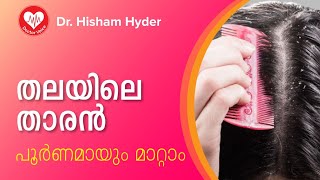 100% താരൻ അകറ്റാനുള്ള ഒറ്റമൂലികൾ | Dandruff Treatment at Home in Malayalam| Dandruff Malayalam