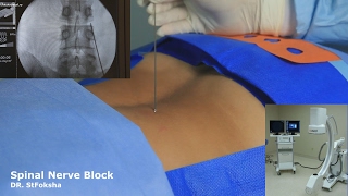 Блокада Позвоночника под Контролем | Spinal Nerve Block