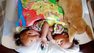 Conjoined Twins: Maria and Teresa
