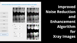 Improved Noise reduction and Enhanced algorithm for Xray Images
