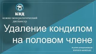 634  Удаление кондилом на половом члене