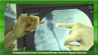 Установка уретерального стента мемокат (Memokath)