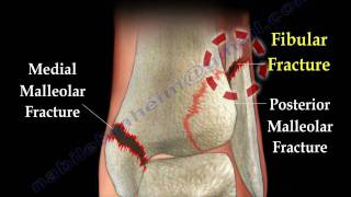 Ankle fracture / Fractures and its repair- Everything You Need To Know - Dr. Nabil Ebraheim