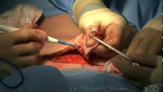 Mini Tummy Tuck for Mommy Makeover