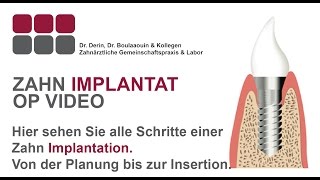 Zahn Implantat Frankfurt