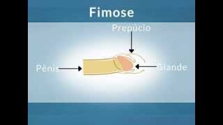 Fimose