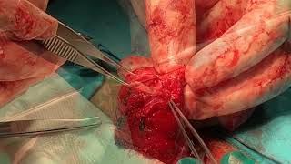 Penile Cancer-Partial Penectomy
