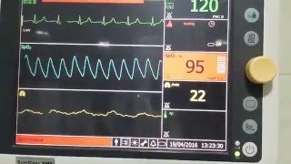 Watch live the ECG/EKG notice tall T waves n loss of P waves: Hyperkalemia