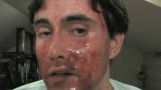 Laser skin resurfacing