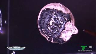 Dott. Francesco Dimeco Direttore Dip. Neurochirurgia
