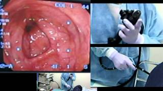 Total Colonoscopy; 手前壁押し潰し理論05