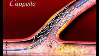 Stent insertion