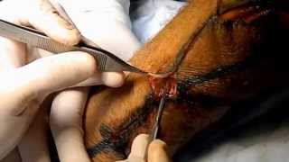 colgajo sural 1