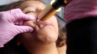 how to use hyaluron pen smile lines/forehead(part5)