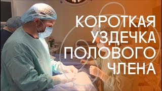Пластика короткой уздечки полового члена. Френулотомия. Как проходит операция