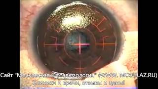 Лазерная коррекция астигматизма - видео операции