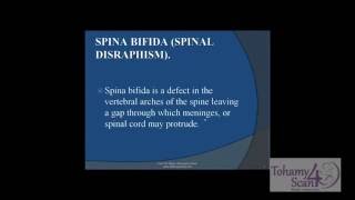 4D Ultrasound - Obstetric Ultrasound - Spina Bifida Cystica (Spinal Dysraphism) in 4D Scan
