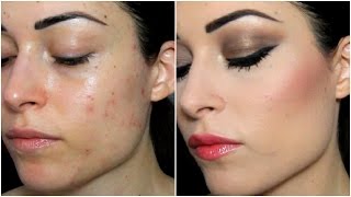COME COPRO LE  MACCHIE DA ACNE (base estiva a lunga tenuta) | CherylPandemonium