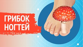215  Лечение запущенной формы грибка ногтей