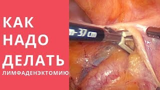 КАК НАДО делать тазовую лимфаденктомию