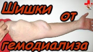 Как предотвратить шишки на руке от гемодиализа