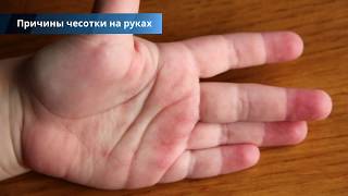 Чесотка на руках: лечение, фото с описанием, причины, симптомы и народные средства