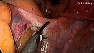 Laparoscopic Surgery for Uterine Prolapse