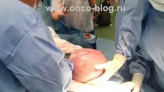Удаление миомы матки