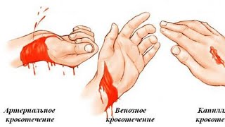 Остановить кровотечение. Артерильное и Венозное кровотечение