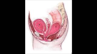 Cloaca  repair, urogenital sinus mobilisation